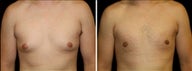 20 year old male, male breast reduction