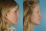 Revision Rhinoplasty