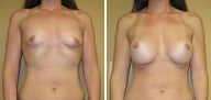 Breast Augmentation