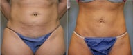 43 year old female with mini tummy tuck