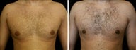 24 year old male, male breast reduction