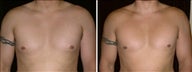 33 year old male, male breast reduction