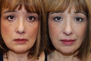 Silikon-1000 for undereyes, nasolabial folds, lips and corners of mouth. 