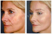Facelift