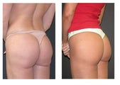 Brazilian Butt Lift 