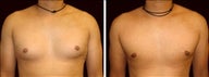 29 year old male, male breast reduction
