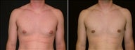 23 year old male, male breast reduction