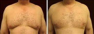 52 year old male, male breast reduction
