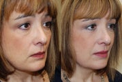 Silikon-1000 for undereyes, nasolabial folds, lips, and corners of mouth.