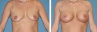 Breast Augmentation