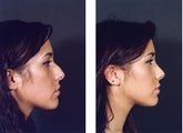 Rhinoplasty