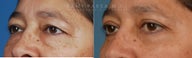 Before and After Upper and Lower Eyelid Blepharoplasty