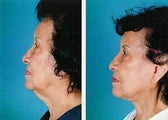 S-Lift