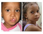 Cleft Lip and Palate Repair