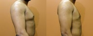 Male Breast Reduction