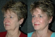 Facelift