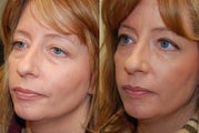 Lower eyelid rejuvenation with Silikon-1000