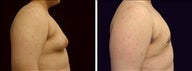 16 year old male, male breast reduction