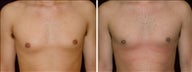 22 year old male, male breast reduction