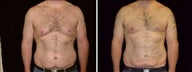 26 year old male, male breast reduction