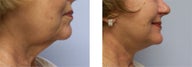 Face and Neck Lift