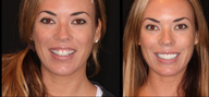 Before & After Smile Make-Over-Upper 8 Veneers