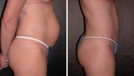 Liposuction