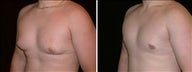 17 year old male, male breast reduction
