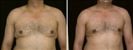 26 year old male, male breast reduction