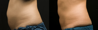 CoolSculpting