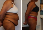Large Abdominoplasty 3 months before and after
