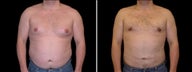 33 Year Old Male, male breast reduction