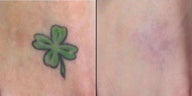 PicoSure Tattoo Removal on Green Ink