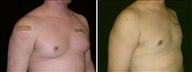 26 year old male, male breast reduction