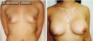 20 year old female treated with breast augmentation