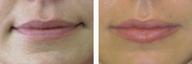 Juvederm for Fuller, Plump Lips