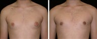 17 year old male, male breast reduction