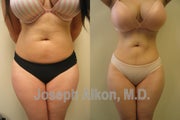 Liposuction