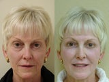 55 year old female treated for volume loss of the face with fat transfer (grafts)