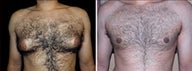 30 year old male, male breast reduction