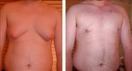 16 year old male, male breast reduction surgery