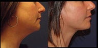 Neck lift, lower face lift 