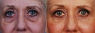 Lower eyelid blepharoplasty autologus fat injection