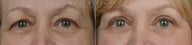 before and after bilateral upper eyelid blepharoplasty
