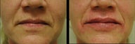 Juvederm