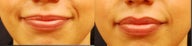 Restylane Lip Augmentation