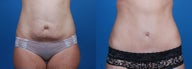 Tummy Tuck