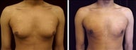 22 year old male, male breast reduction