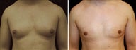 28 year old male, male breast reduction