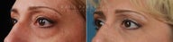 Before and After upper and lower eyelid blepharoplasty